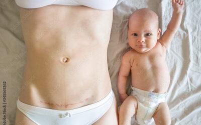 Recovering from a Cesarean Section
